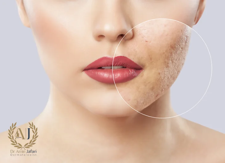 درمان جای جوش با لیزر