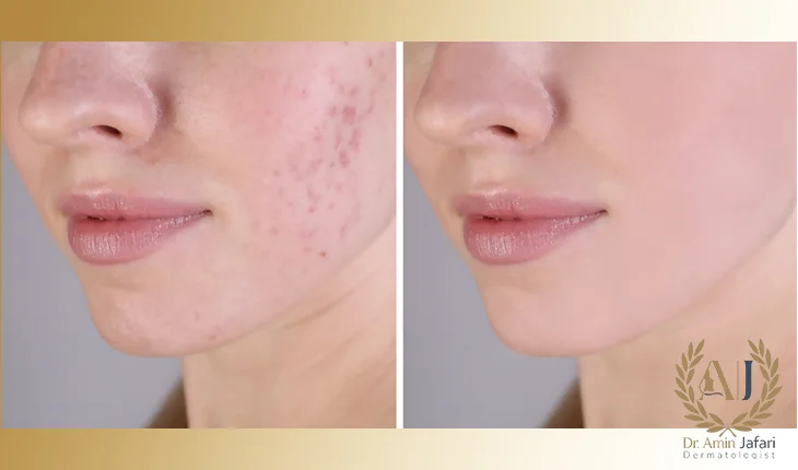 مزایای درمان جای جوش