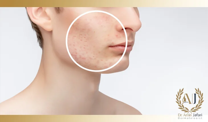 دوره درمان جای جوش با لیزر