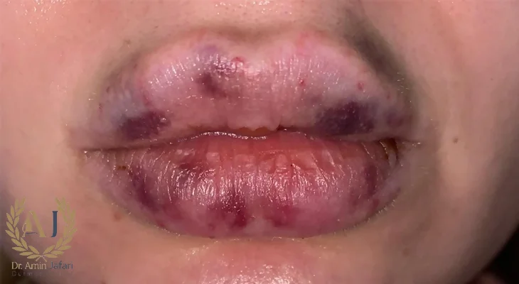 علائم نکروز بعد از تزریق ژل