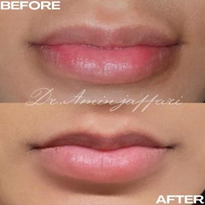 نمونه کار تخلیه ژل