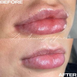 نمونه کار تخلیه ژل