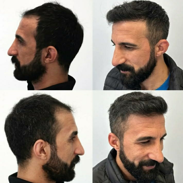 مراقبت بعد از کاشت مو و ابرو