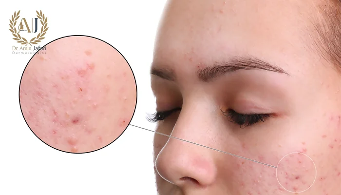 درمان جای جوش با اندولیفت