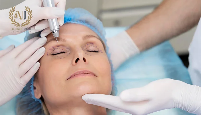 صورت اندولیفت