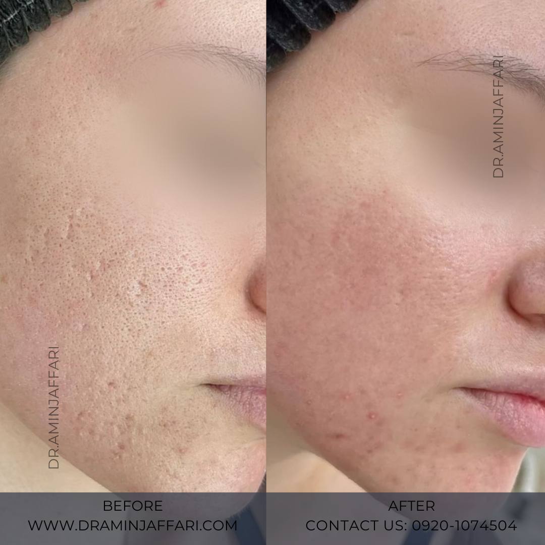 درمان جای جوش و لک -دکتر امین جعفری (1)