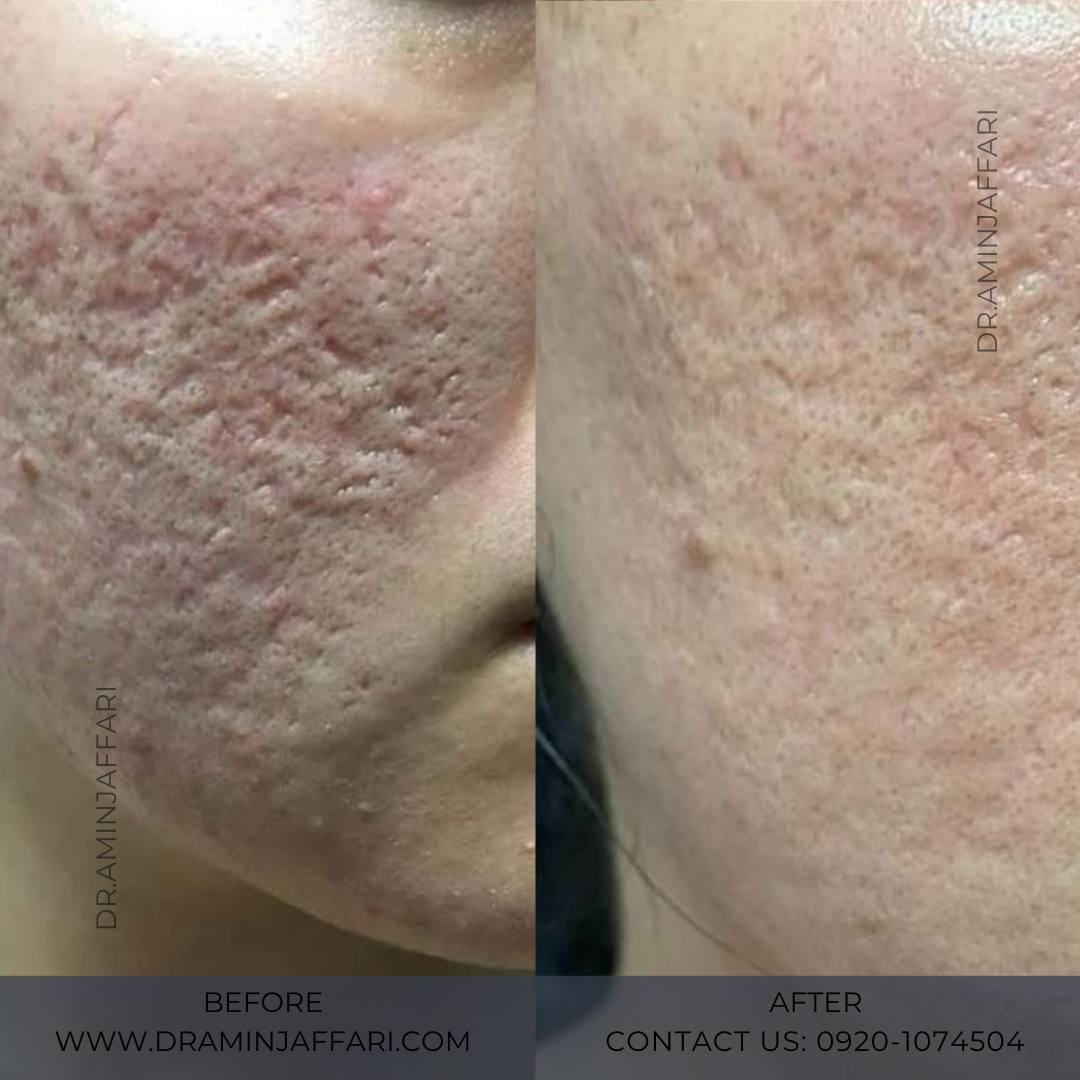 درمان جای جوش و لک -دکتر امین جعفری (10)