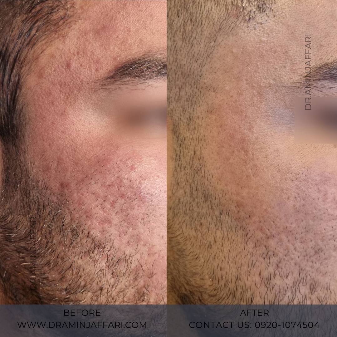 درمان جای جوش و لک -دکتر امین جعفری (12)