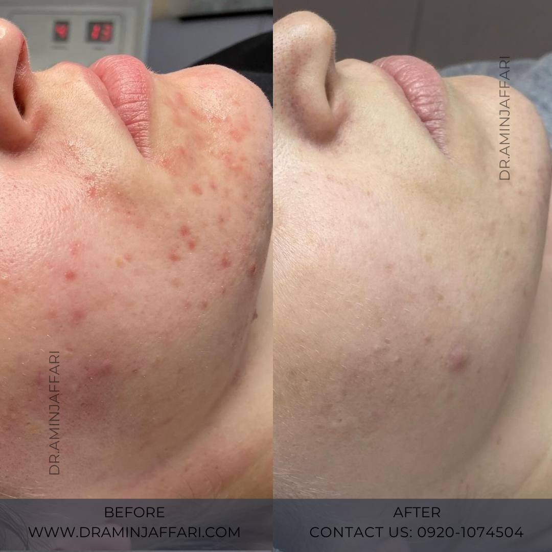 درمان جای جوش و لک -دکتر امین جعفری (13)