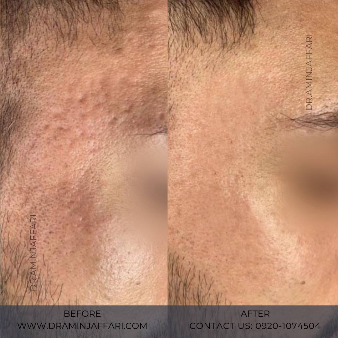 درمان جای جوش و لک -دکتر امین جعفری (3)