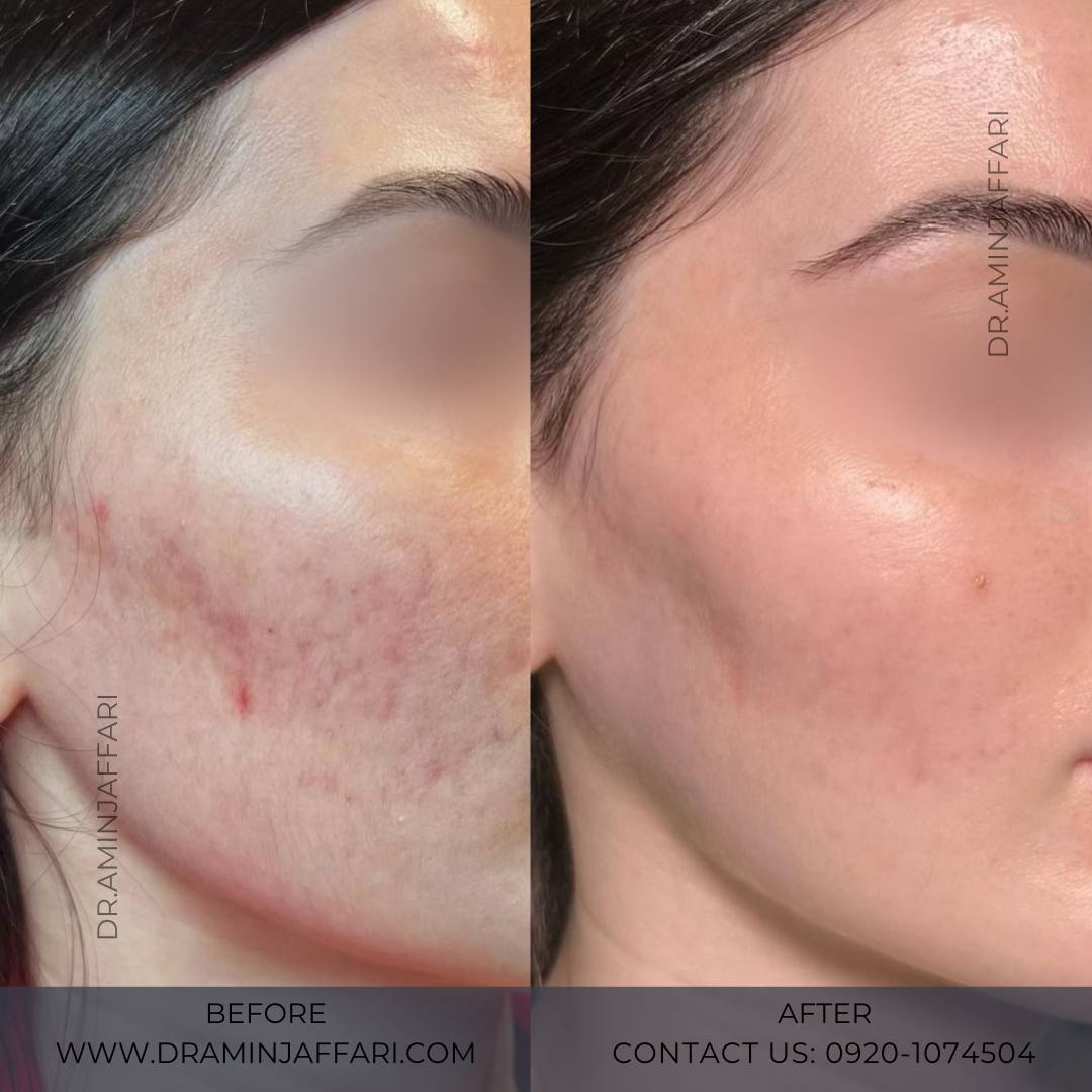 درمان جای جوش و لک -دکتر امین جعفری (6)