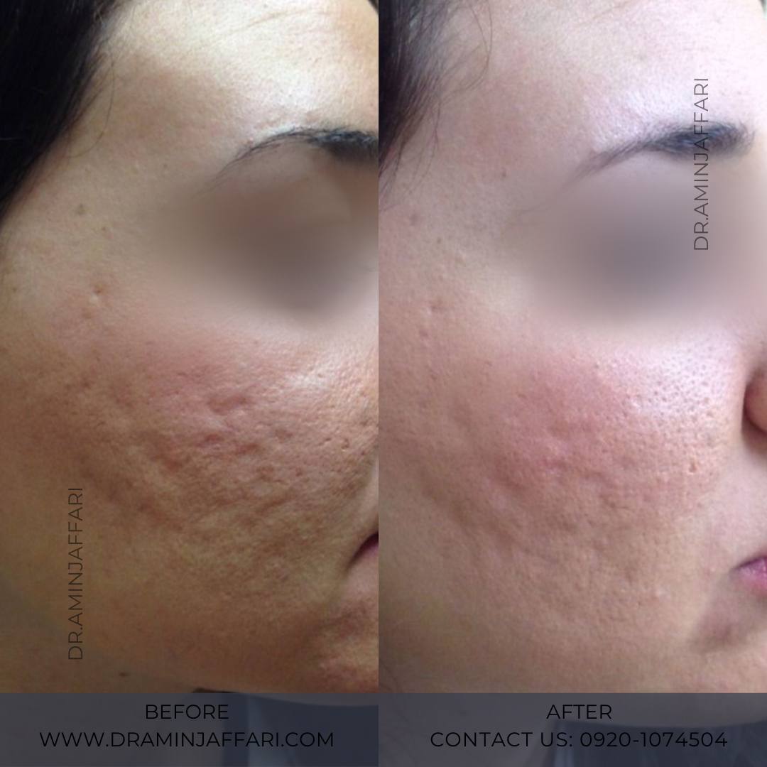 درمان جای جوش و لک -دکتر امین جعفری (8)