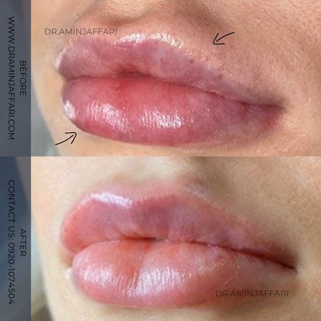 تخلیه ژل - دکتر امین جعفری (10)