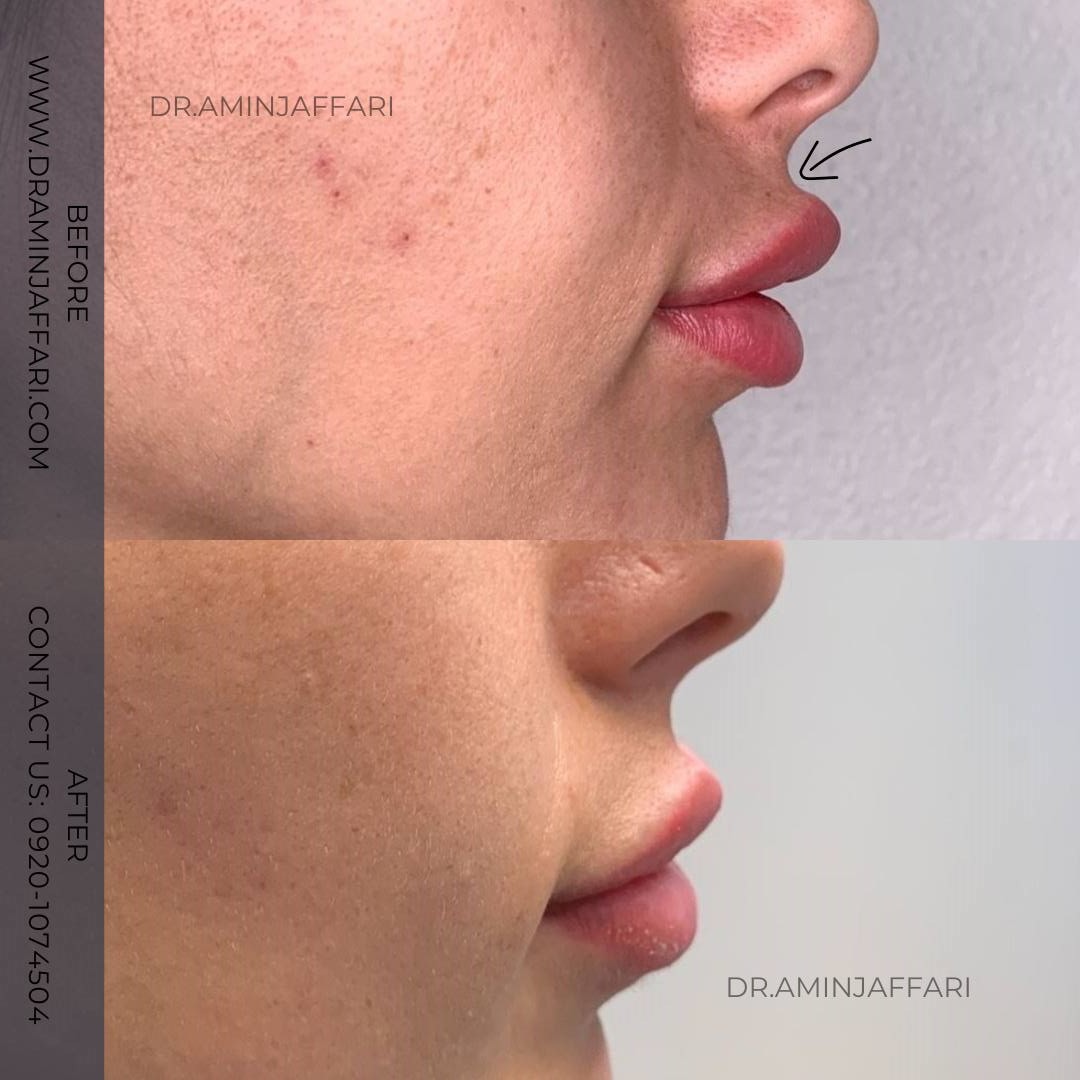 تخلیه ژل - دکتر امین جعفری (11)