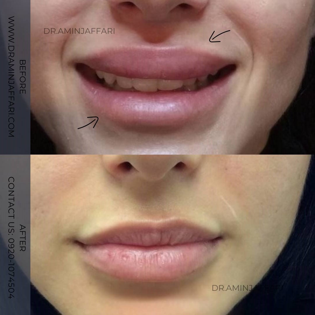 تخلیه ژل - دکتر امین جعفری (12)