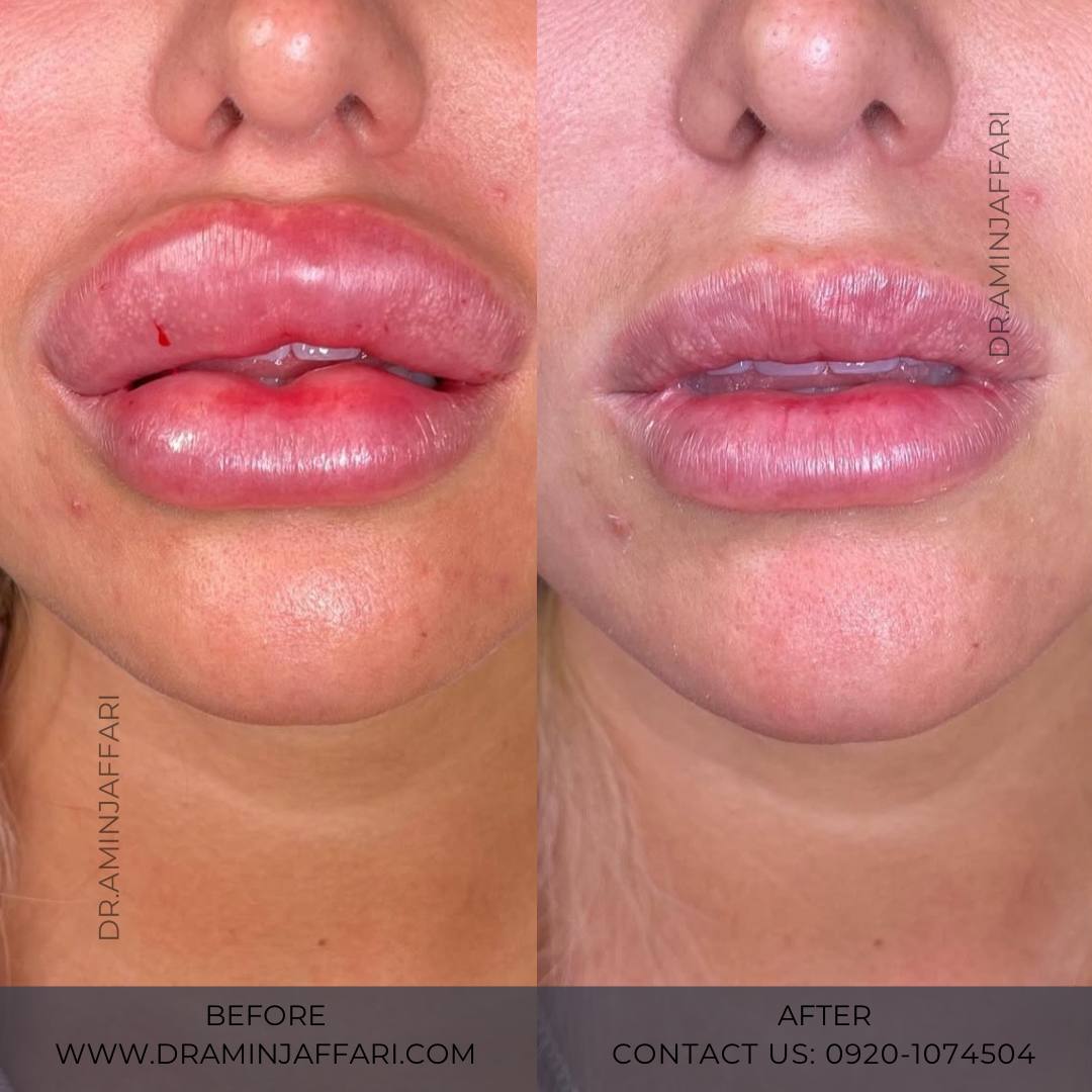 تخلیه ژل - دکتر امین جعفری (17)