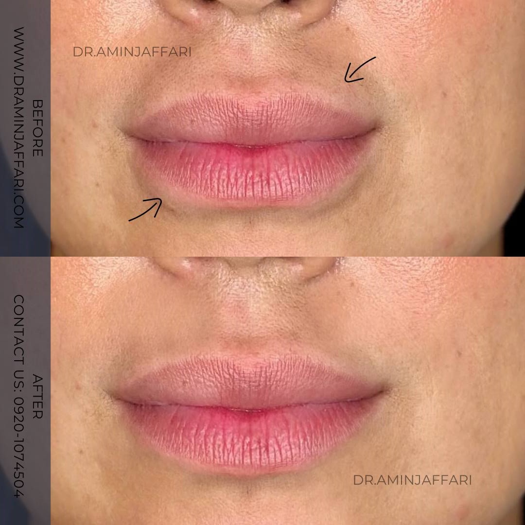 تخلیه ژل - دکتر امین جعفری (3)