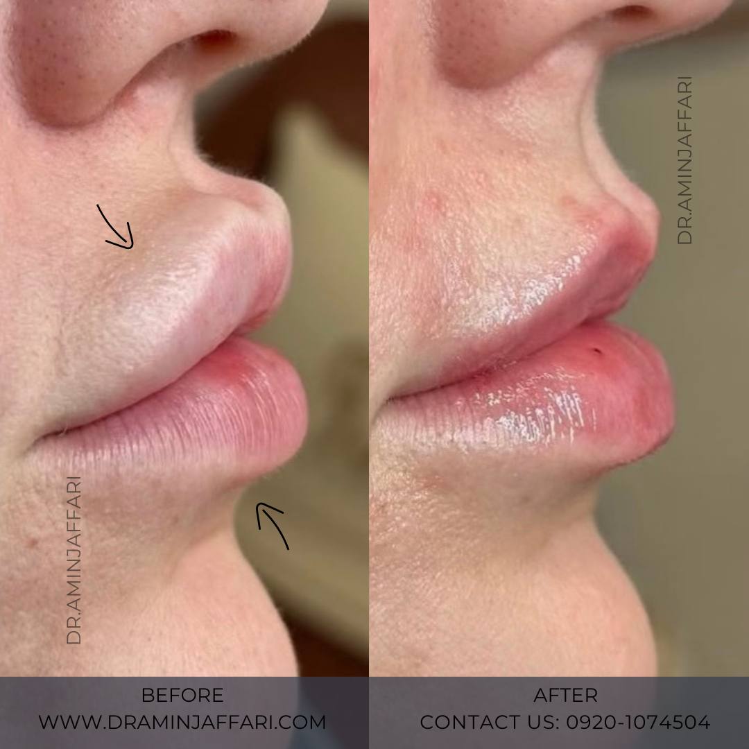 تخلیه ژل - دکتر امین جعفری (5)