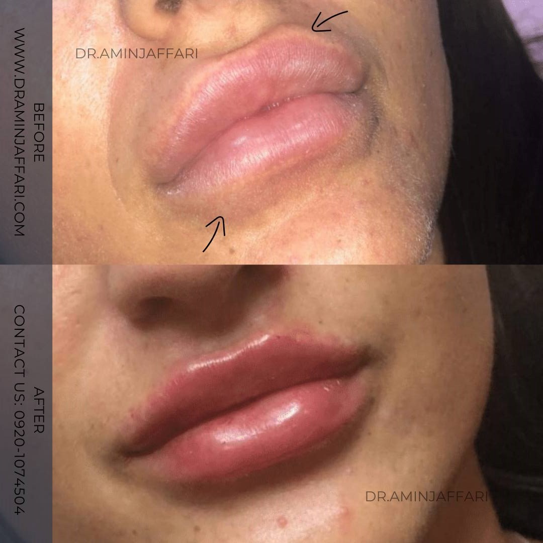 تخلیه ژل - دکتر امین جعفری (8)