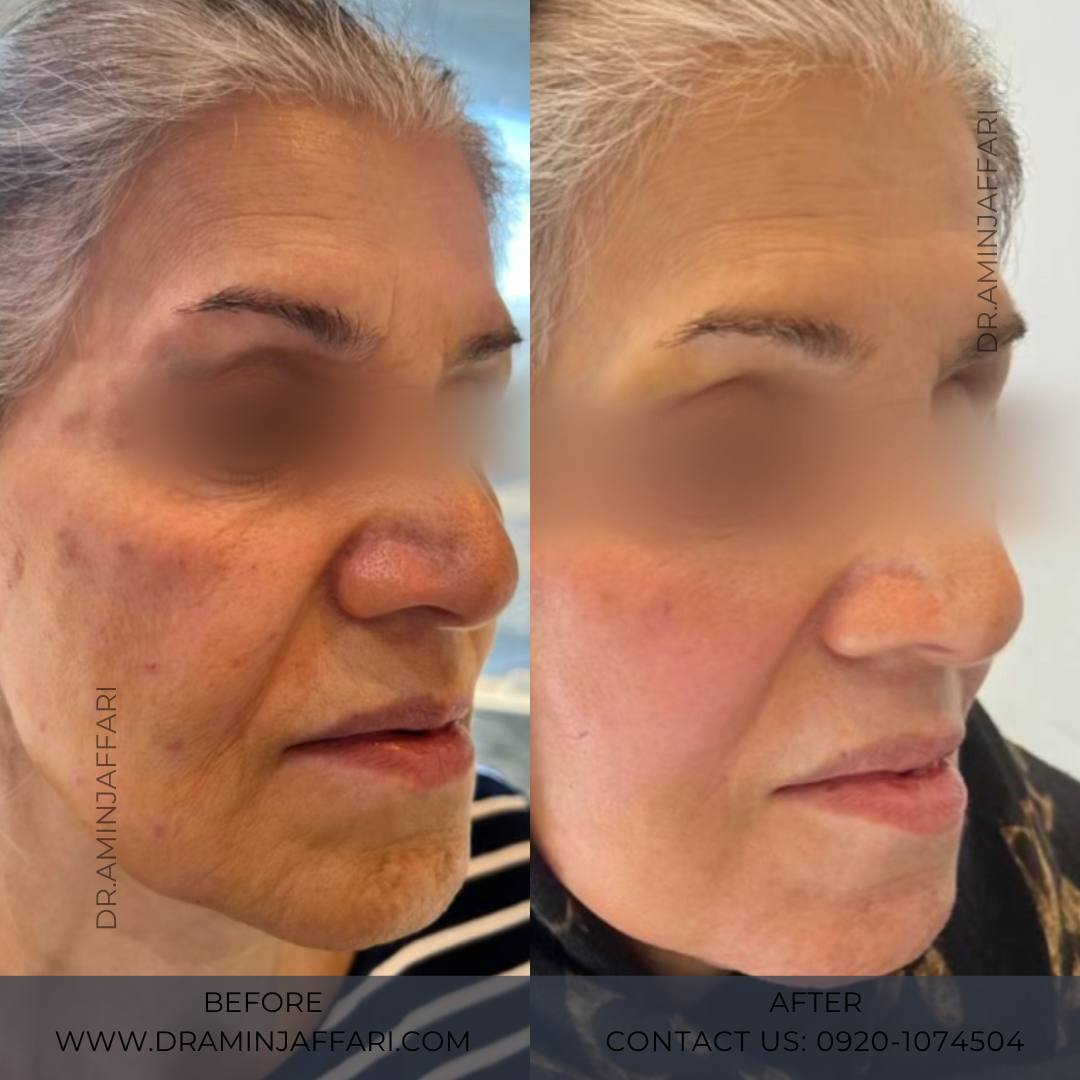 اندولیفت دکتر امین جعفری (11)