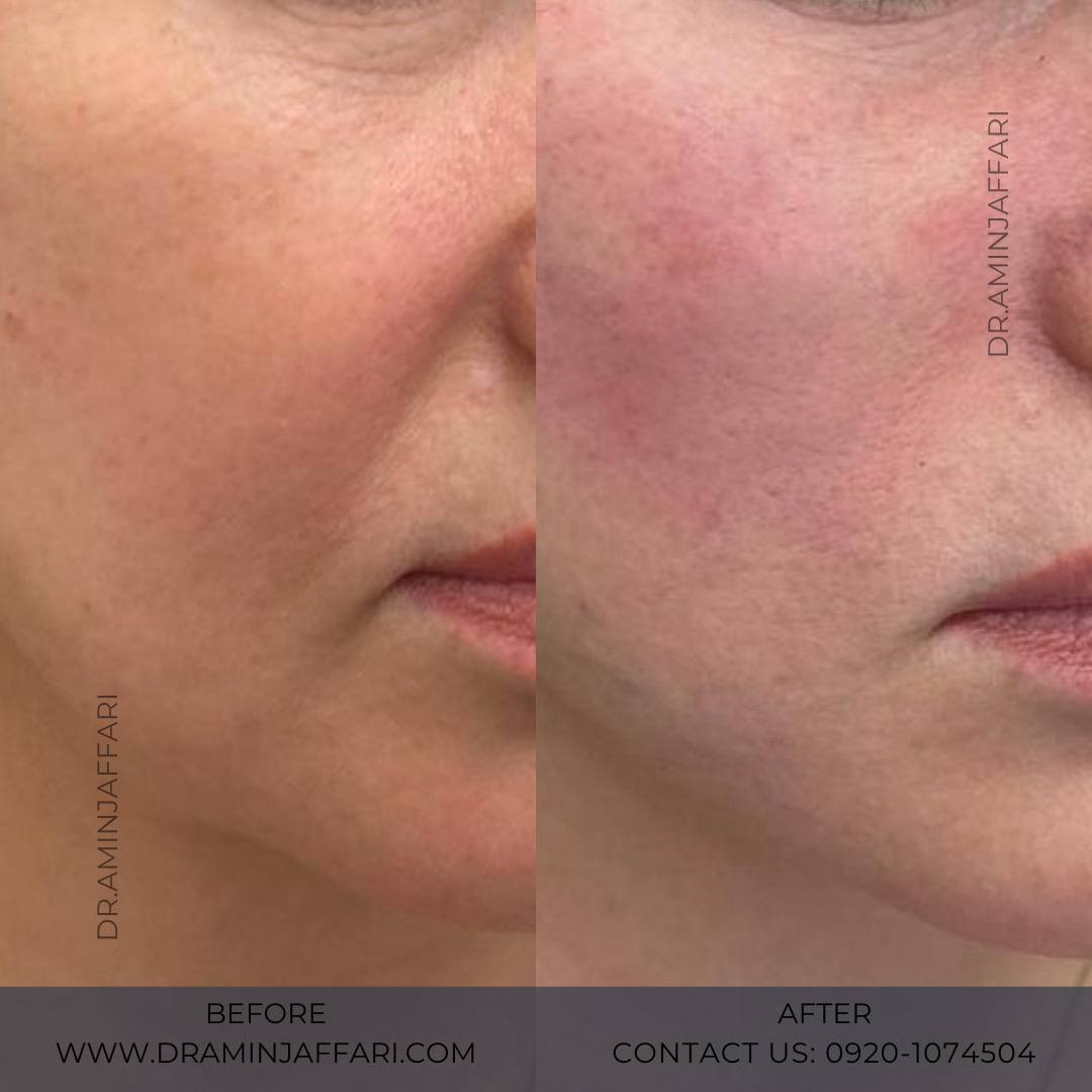 اندولیفت دکتر امین جعفری (11)