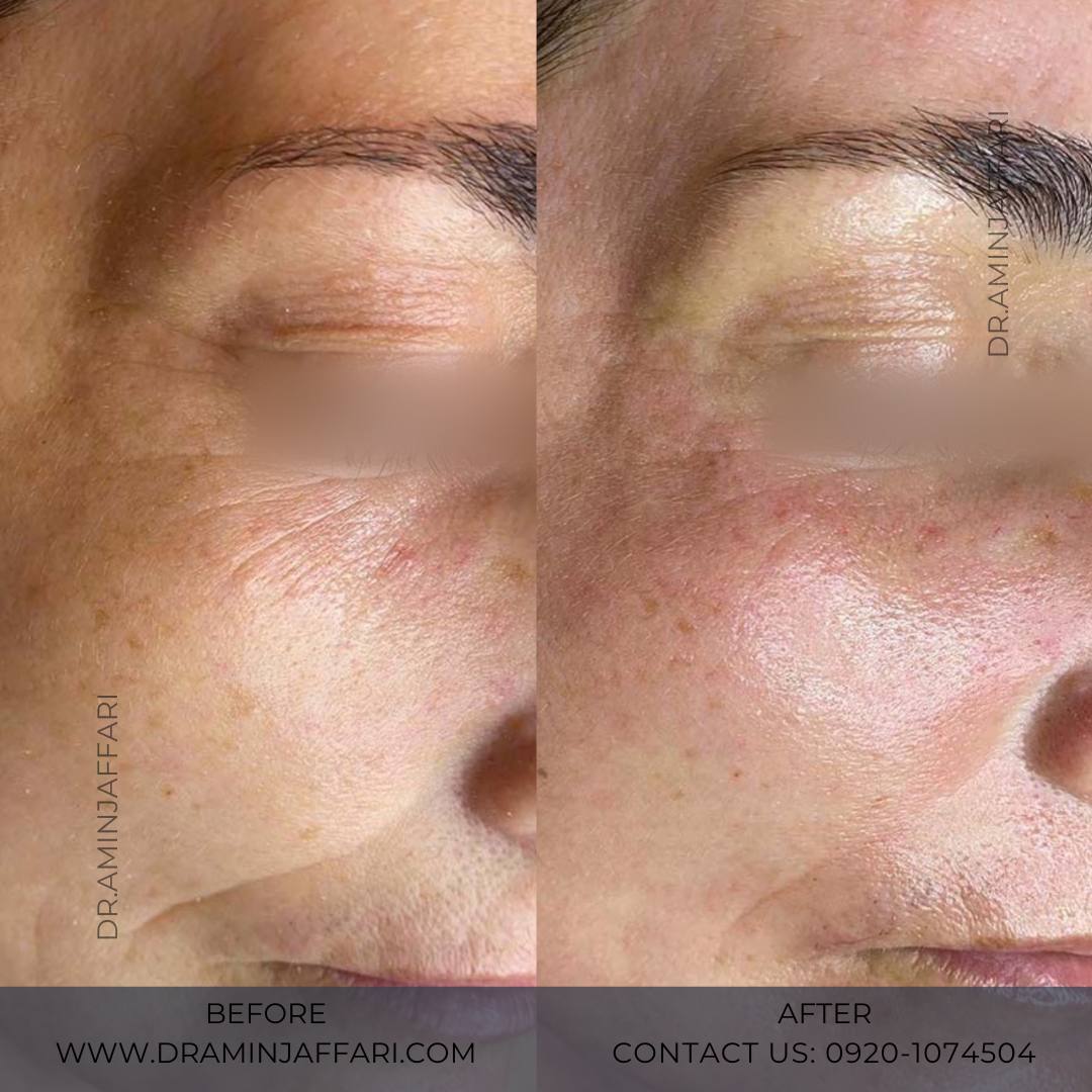 اندولیفت دکتر امین جعفری (13)