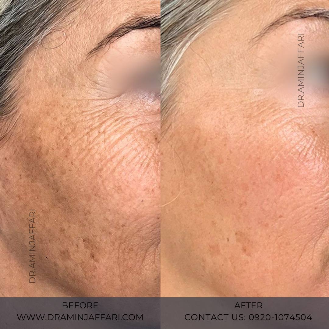 اندولیفت دکتر امین جعفری (2)