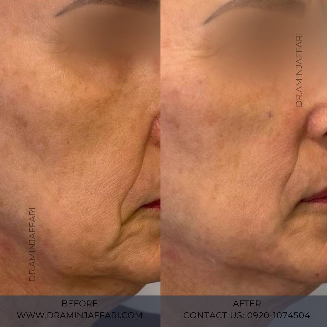 اندولیفت دکتر امین جعفری (6)