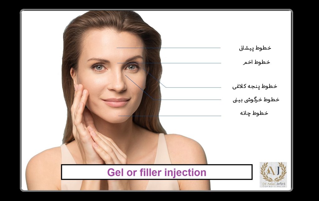 تزریق ژل یا بوتاکس نواحی تزریق