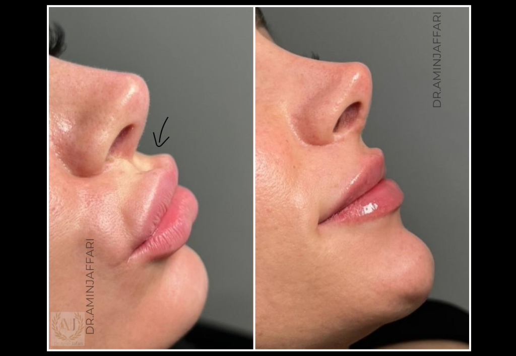 تخلیه ژل پاژ دکتر امین جعفری