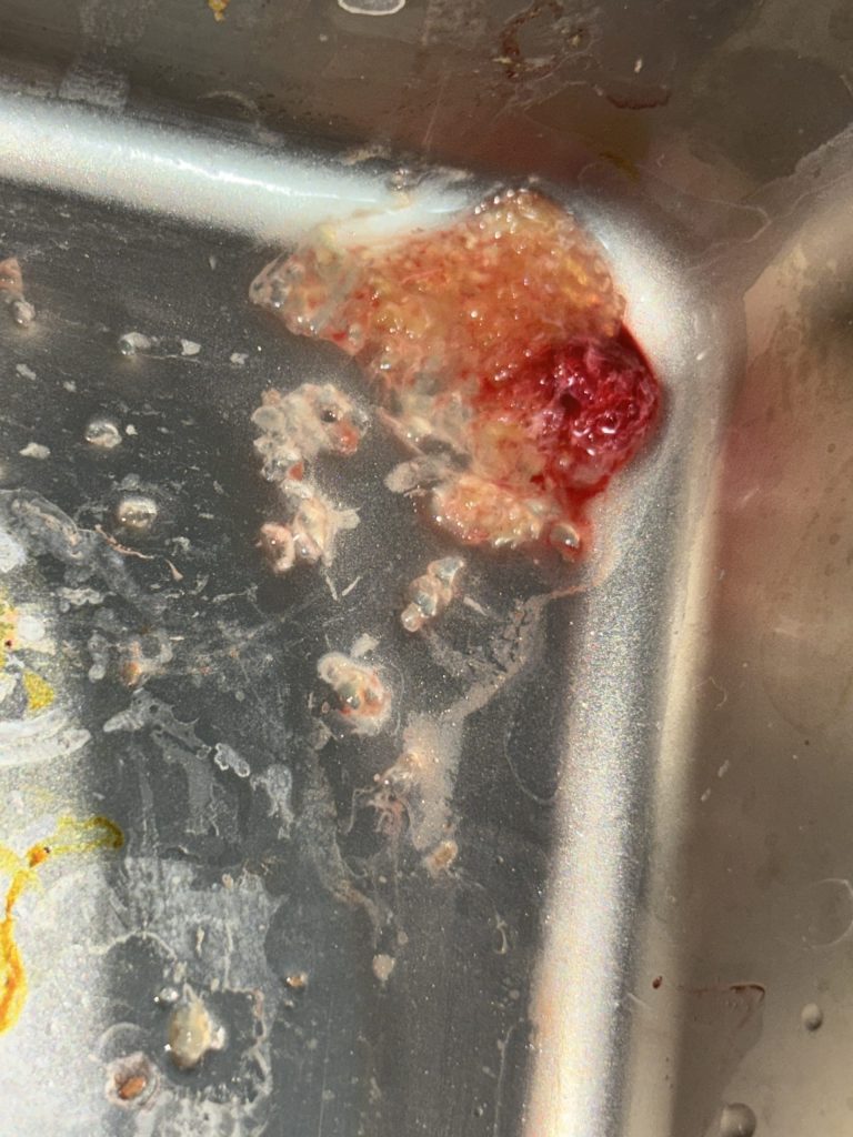 تخلیه ژل بیکینی دکتر امین جعفری.