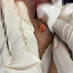 تخلیه ژل بیکینی دکتر امین جعفری