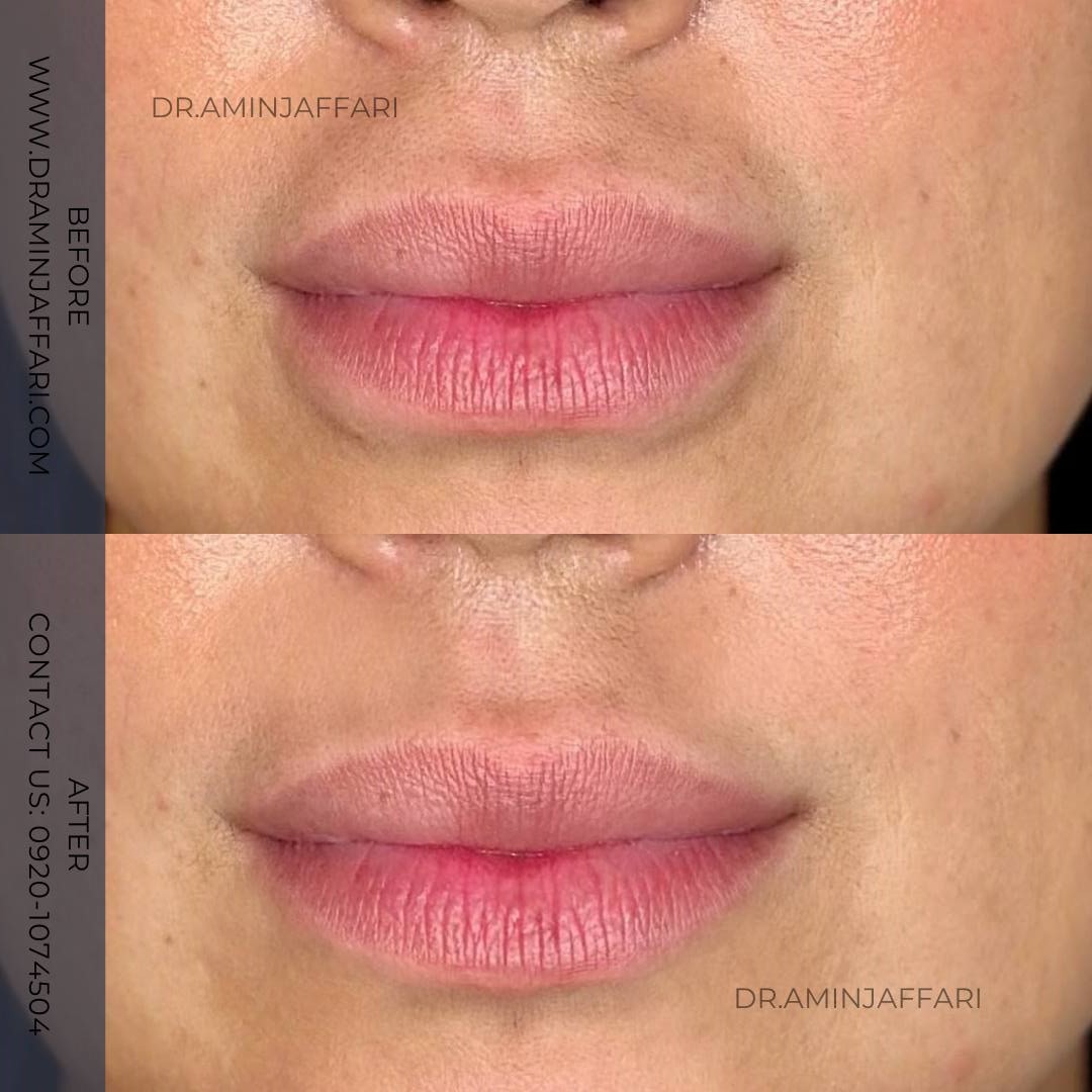 تخلیه ژل لب دکتر امین جعفری (6)