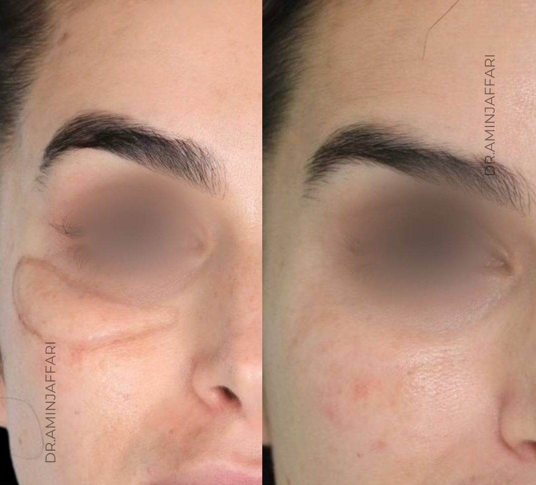 تخلیه ژل و چربی صورت