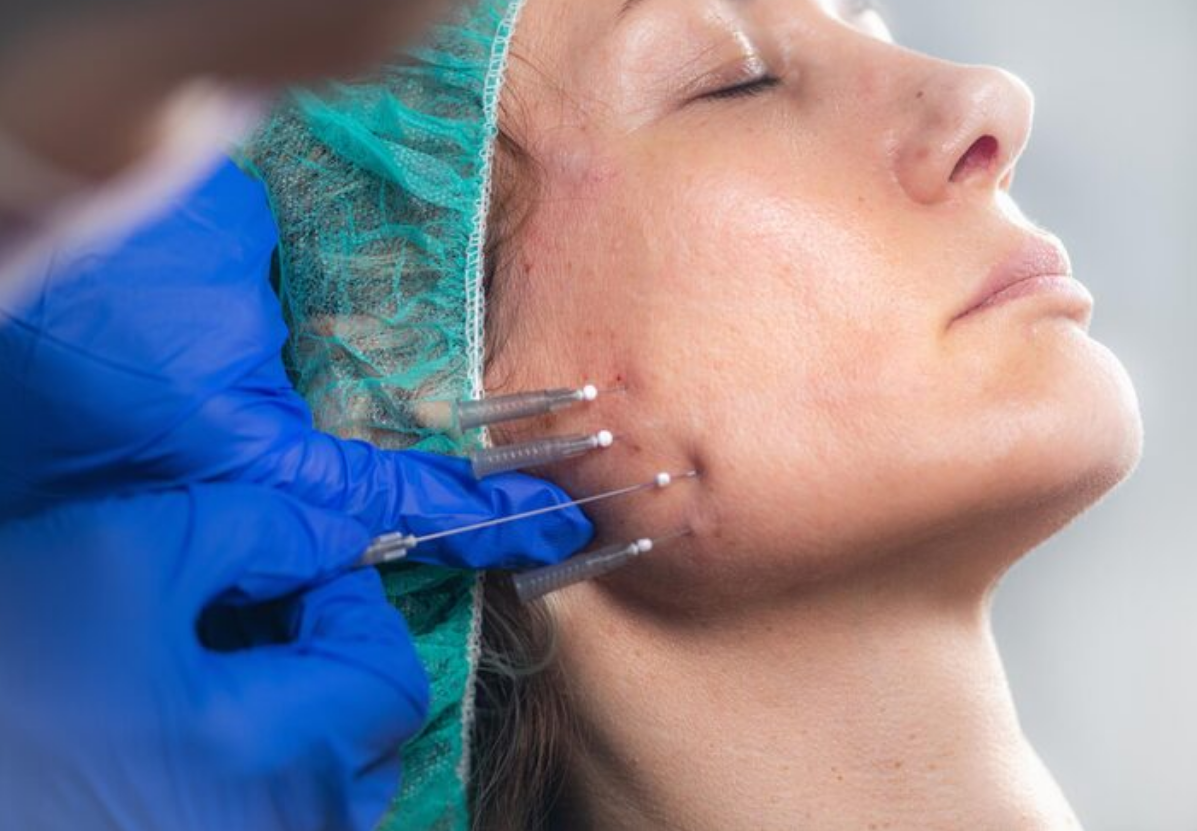 خارج سازی انواع نخ ( لیفت، امبدینگ)..