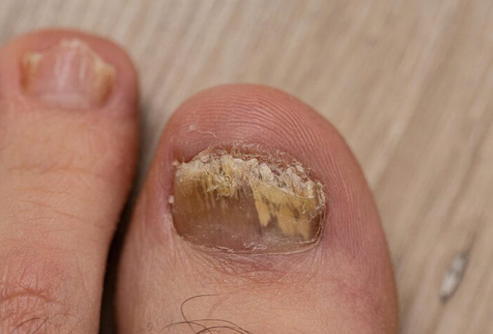 درمان بیمارهای ناخن1