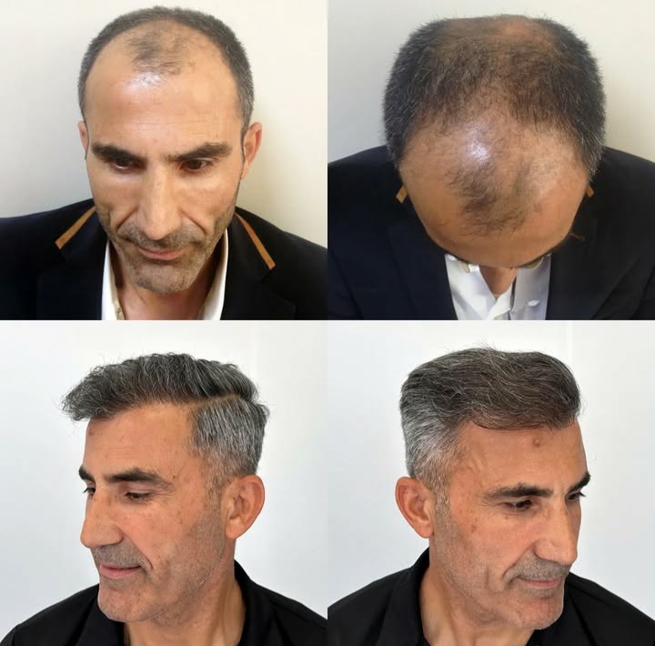 کاشت مو و ابرو (16)