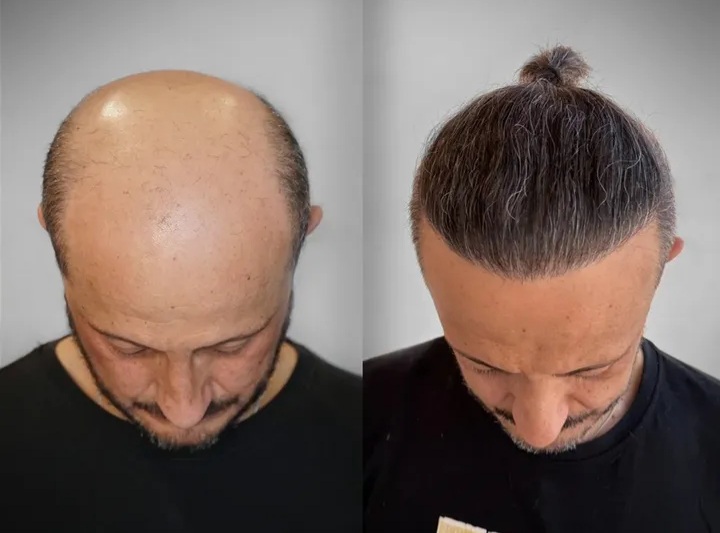 کاشت مو و ابرو (18)